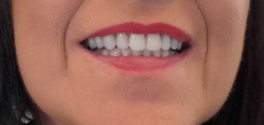 Implant Retained fitted by Clinical Denture Centre, Deal Kent